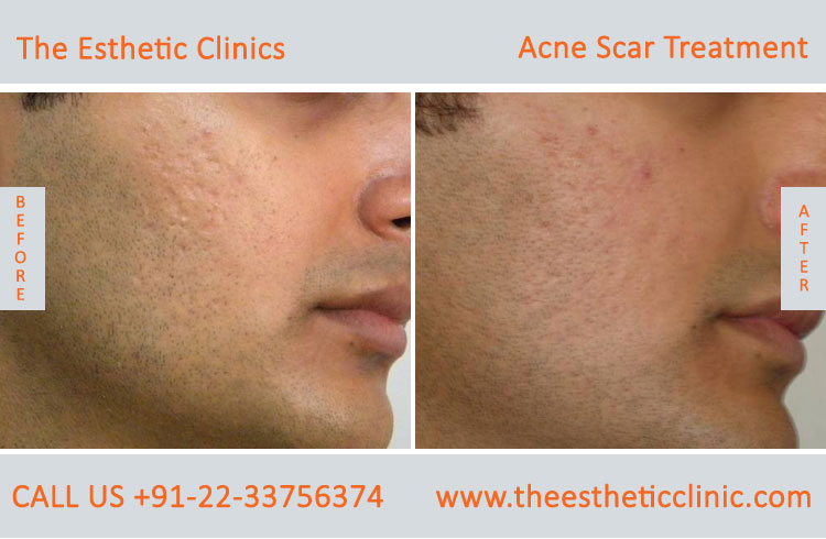 face acne scars removal laser treatment before after photos in mumbai india (6)